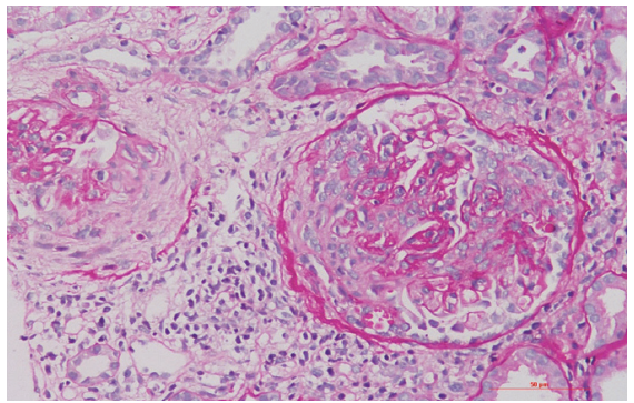 Renal biopsy showing two glomeruli with fibrocellular crescents and focal rupture of the Bowman capsule (periodic acid Schiff stain, 200×).