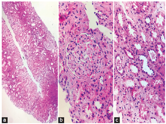 (a) Hematoxylin and eosin staining of renal biopsy (10x) showing one normal glomerulus, dilated tubules and interstitial inflammation, (b) Golden brown pigment deposits (hemosiderin) in tubules (HE,300x), (c) Atrophic and dilated tubules with brown pigment and interstitial inflammation (HE,300x).