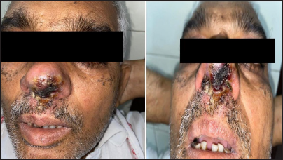 Necrotic lesion measuring 1.5 × 1 cm on nasal tip over columella extending to left nasal ala, septum, and bilateral vestibule. Overlying skin was erythematous and showed crusting. It was nontender and had no pus discharge or bleeding. Fungal potassium hydroxide (KOH) mount was negative for mucormycosis and was suggestive of acute inflammatory exudate without any granuloma formation.