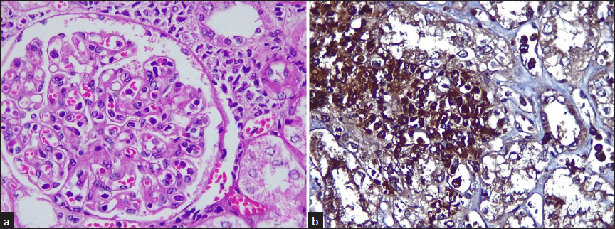 Kidney biopsy images (a) Light microscopy with periodic acid schiff staining 40×. Several large-sized atypical cells infiltrating in capillary lumina of a glomerulus and (b) Immunocytochemistry. Atypical cells show strong cytoplasmic positivity for myeloperoxidase (MPO). They were negative for CD20, CD3, and CD117 (magnification 40x).