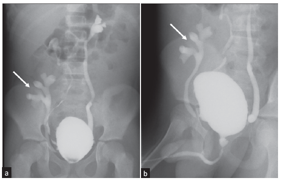 (a-b) Spot images of micturating cystourethrography show grade II vesicoureteral reflux on the right side and grade III vesicoureteral reflux on the left side. Grade III vesicoureteral reflux is seen in the transplanted kidney in the right iliac fossa (arrows in a and b).