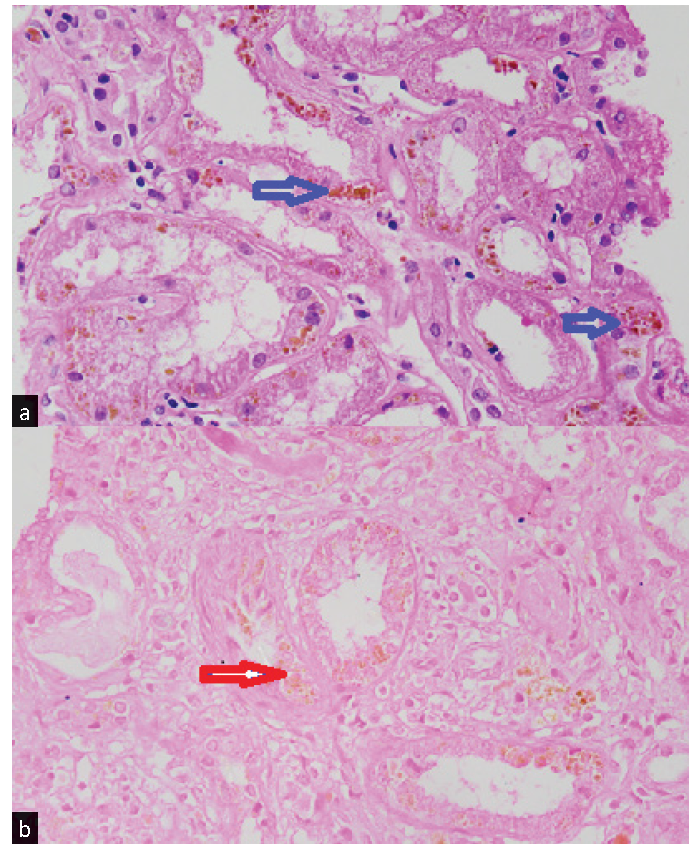 (a) Histopathology of the renal biopsy specimen showing accumulation of golden-brown pigment material in the cytoplasm of many tubular epithelial cells (blue arrows). (b): Negative Pearls staining for hemosiderin of the golden-brown pigment (red arrow).