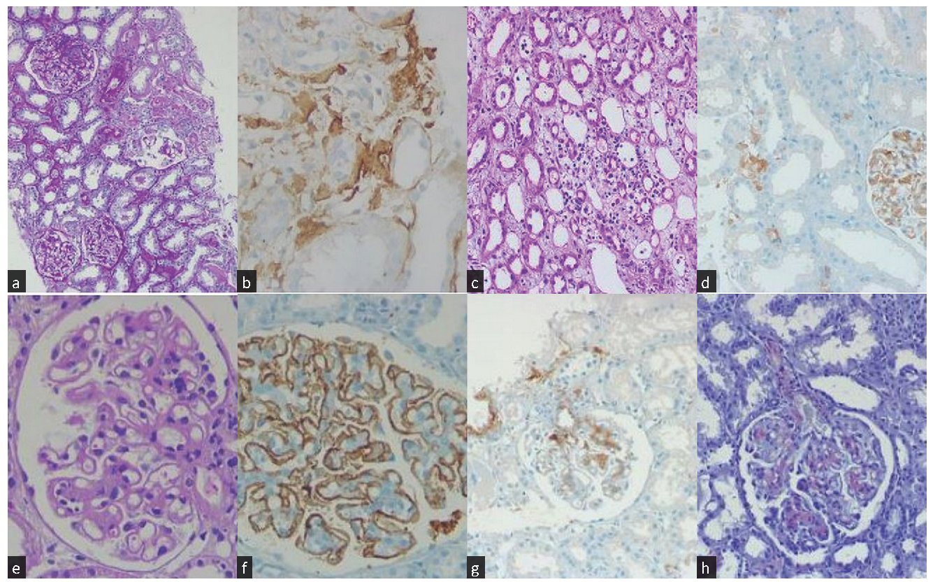 (a) Light microscopy showing calcineurin inhibitor- associated thrombotic microangiopathy (Case1) (100X), (b) Immunohistochemistry showing leukocyte chemotactic factor 2 (ALECT2) Amyloidosis staining (Case 1) (100X), (c) Light Microscopy showing focal interstitial amyloid deposition (Case 2) (200X), (d) Immunohistochemistry showing ALECT2 staining (Case 2) (200X), (e) Light microscopy showing glomerular basement membrane thickening and glomerular amyloid deposits (Case 5) (400X), (f) Immunohistochemistry showing phospholipase A2 receptor positivity (Case 5) (400X), (g) Immunohistochemistry showing ALECT2 staining (Case 5) (200X), (h) congo red positivity under polarised light (Case 5) (200X).