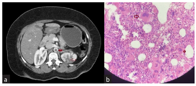 (a) Contrast-enhanced CT abdomen showing infarcts in left kidney (thin red arrow) and thrombus in suprarenal aorta (thick red arrow). (b) Bone marrow image showing megakaryocytic (thick red arrows) hyperplasia.