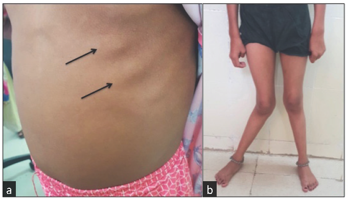 (a) Chest photograph showing rachitic rosary at left costochondral junction (black arrows), (b) Bilateral lower limb photograph showing genu valgus deformity.