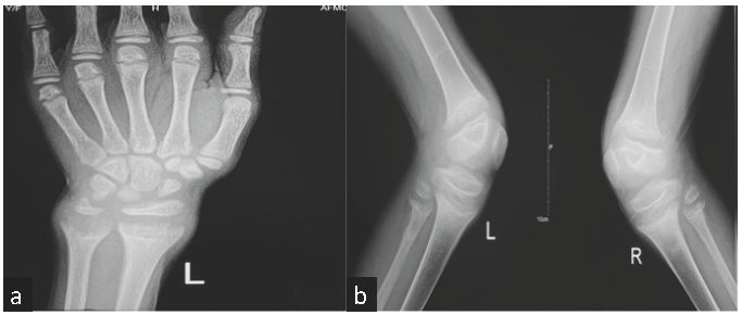 (a) Wrist radiography showing features of rickets, (b) bilateral knee radiography showing features of rickets (cupping, splaying, and fraying).