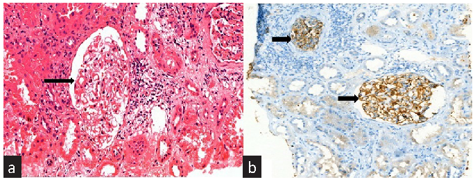 (a) Light microscopy reveals diffuse thickening of the glomerular basement membrane (black arrow) (H&E stain, 400´ magnification). (b) Immunohistochemistry for PLA2R demonstrates diffuse granular positivity along the glomerular basement membrane (black arrows) (400´ magnification). PLA2R: Phospholipase A2 receptor.