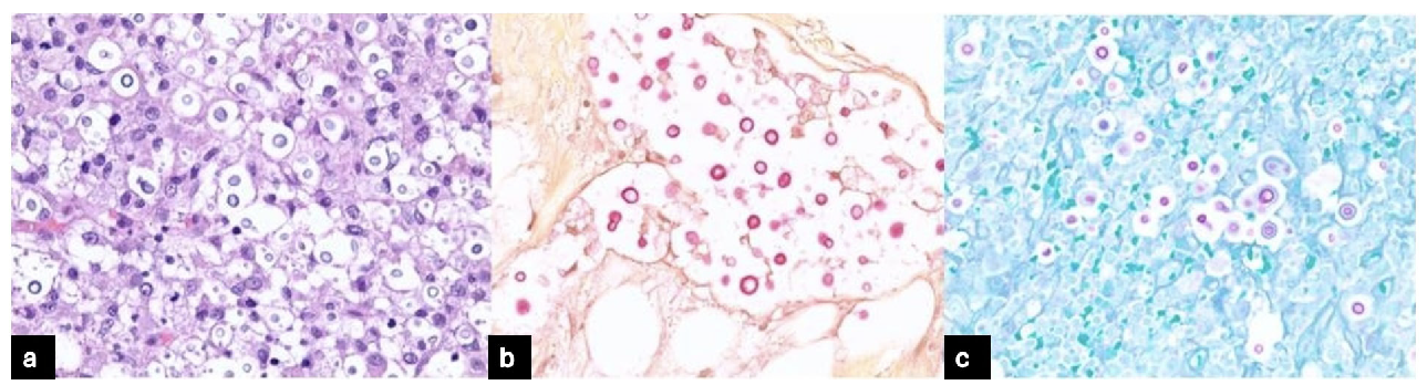 (a) H&E stain showing lymphoid material replaced by granulomatous inflammation with predominance of yeast forms (x100). (b) Mucicarmine stain showing yeast forms (x100). (c) Periodic Acid Schiff stain showing yeast forms (x100). H&E: Hematoxylin and eosin.