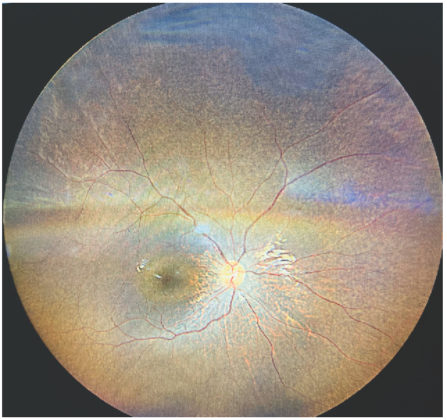 Fundus examination (direct ophthalmoscopy) showing retinitis pigmentosa.