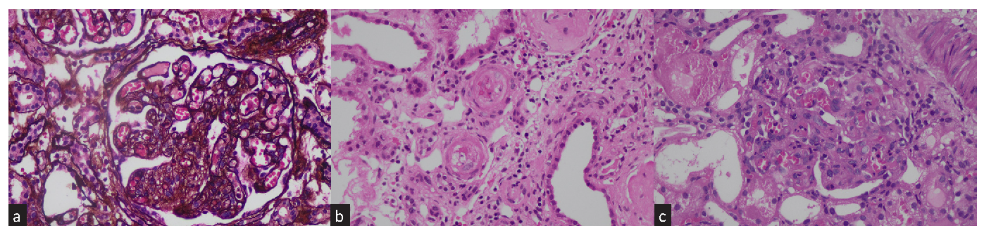 (a) Chronic changes of TMA: Glomerulus shows global capillary wall reduplication along with concomitant endothelial swelling of capillary tuft obliteration, Jones Methenamine silver stain, X400. (b) Acute TMA changes in arteriole with fibrinoid necrosis, endothelial swelling, karyorrhectic nuclear debris, and luminal obliteration, H&E stain, X400. (c) Acute changes of TMA: Glomerulus shows segments of mesangiolysis, endothelial swelling, congestion and karyorrhectic nuclear debris. Adjacent tubules show acute injury with epithelial loss of brush border, epithelial simplification and cytoplasmic protein resorption droplets, H&E stain, X400. TMA: Thrombotic microangiopathy