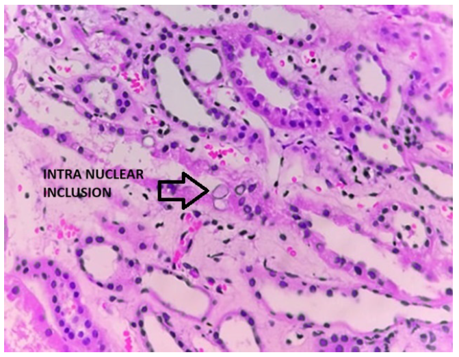 Adenovirus inclusion bodies. Hematoxylin and eosin stain 40x.