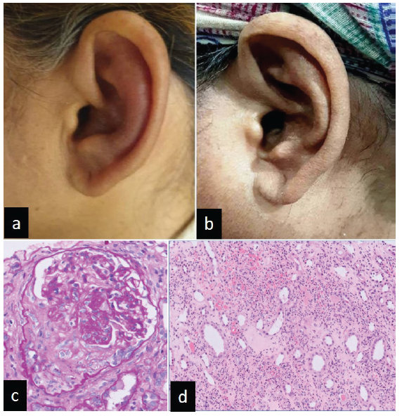 (a) Left ear inflammation of pinna (b) which resolved (c) photomicrograph showing the single viable glomerulus in the biopsy with the fibrocellular crescent (PAS 400x), (d) photomicrograph depicts the medulla with prominent karyorrhexix, neutrophils, and hemorrhage around the vasa recta (H&E 200x). H&E: Hematoxylin and eosin, PAS: Periodic acid schiff.