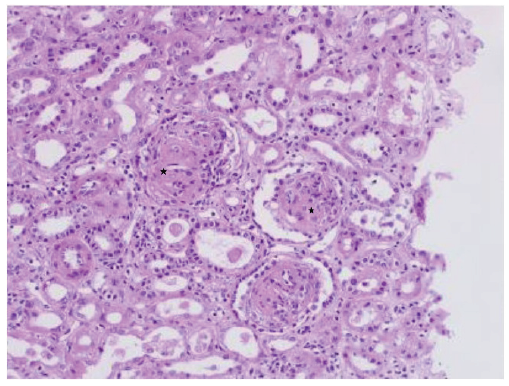 Diffuse mesangial sclerosis shown as widespread global mesangial sclerosis and few focal and segmental lesions involving the capillary tufts (black stars), Light microscopy, hematoxylin and eosin stain, 40x.