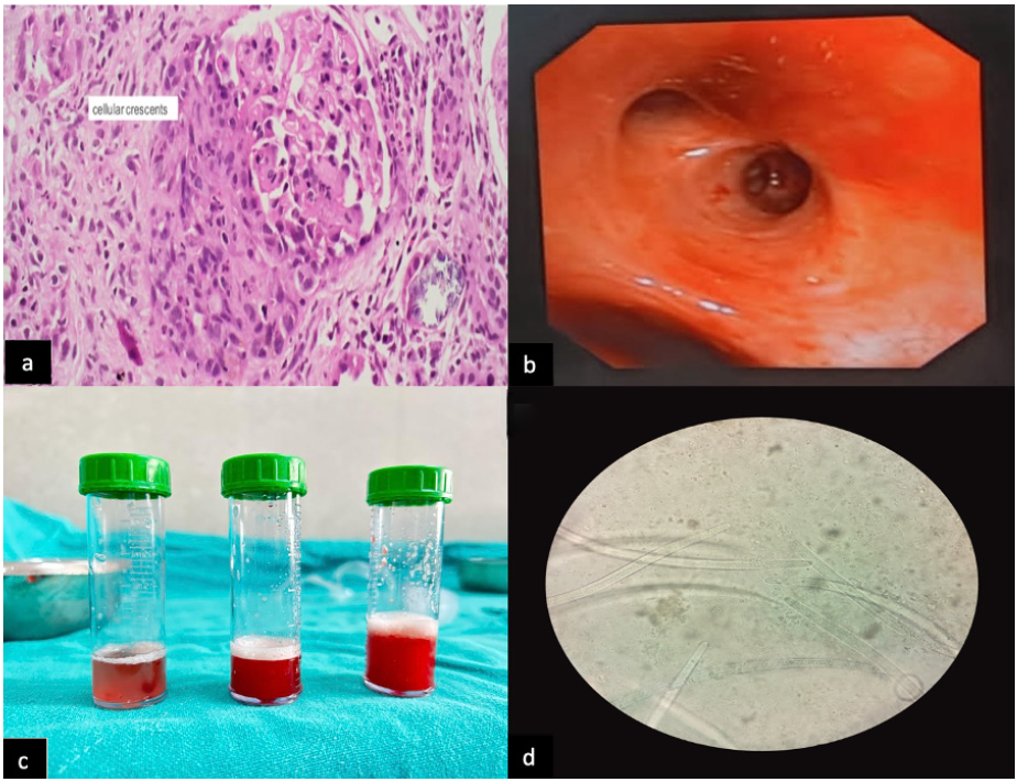 (a) Histopathological Examination (H/P E) of renal biopsy showing cellular crescent (Index admission) High power view (40x). (b) Image of bronchoscopy showing alveolar hemorrhage (day 90 follow-up, on readmission). (c) Broncho-alveolar lavage (BAL) sequential lavage fluid samples suggestive of DAH (day 90 follow-up). (d) Cytopathological examination of BAL fluid showing larvae of Strongyloides stercoralis (40x).