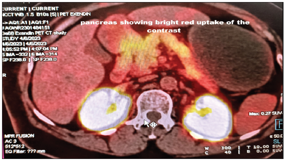 Bright red uptake shown by the Ga-68 EXENDIN tracer throughout the pancreas. The mouse pointer is at the vertebra Axial section showing bright red uptake of the contrast in Positron Emission Tomography-Computed Tomography.