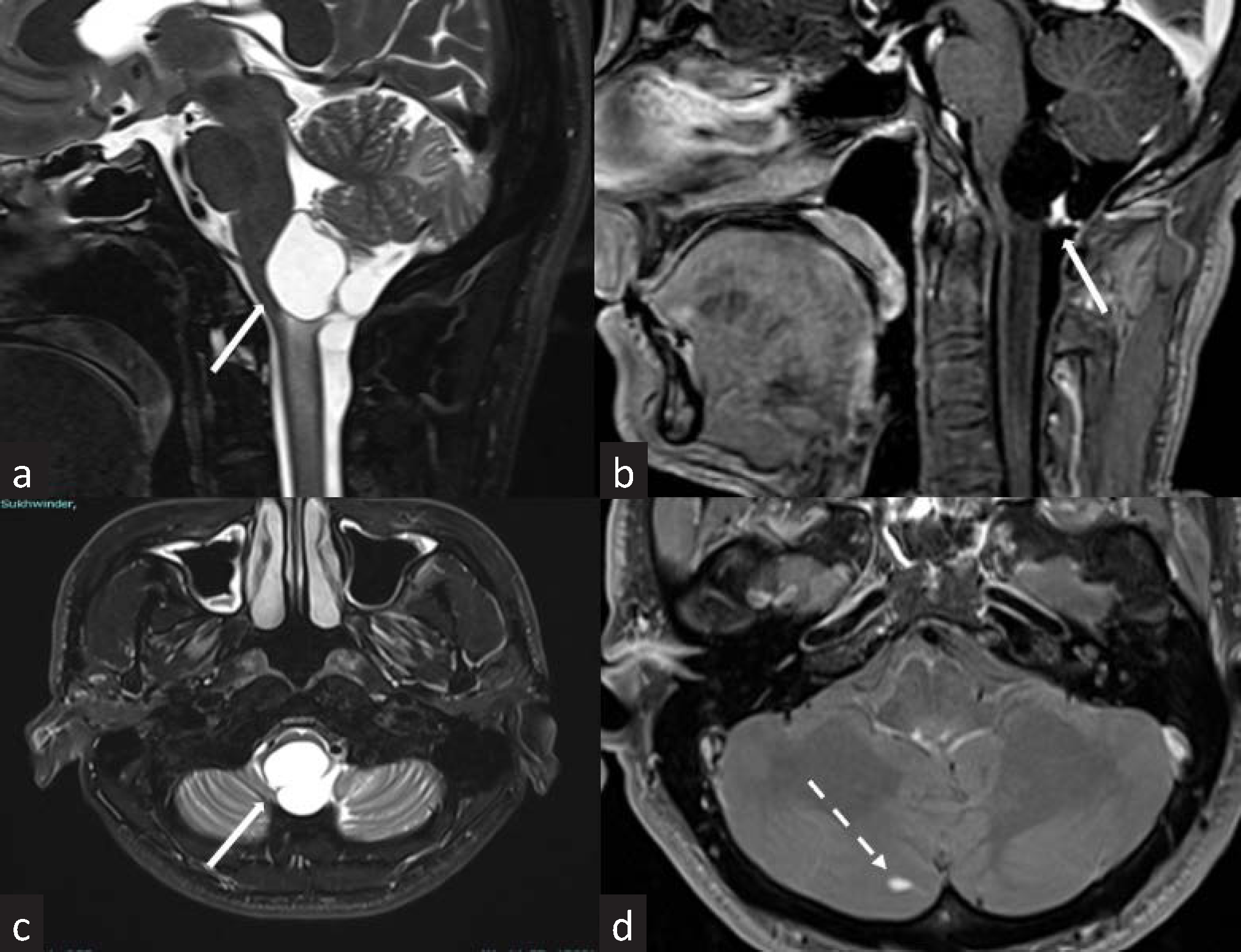 MRI images of brain and cervical spine of a 34-year-old man with VHL. (a-c) Sagittal and axial T2 weighted and postcontrast images reveal a well-defined T2 hyperintense cystic lesion with hyperenhancing mural nodule within the dorsal aspect of the medulla: hemangioblastoma (solid white arrows). (d) Axial postcontrast images show a small intensely enhancing area in the right cerebellar hemisphere: cerebellar hemangioblastoma (dashed white arrow). VHL: Von-Hippel-Lindau.