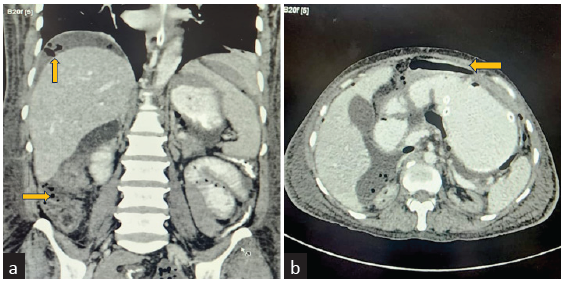 Contrast-enhanced computed tomography images (a) coronal view and (b) axial view showing multiple extra-luminal air attenuating foci in the non-dependant portion of the intra-peritoneal compartment of the abdomen (yellow arrows).
