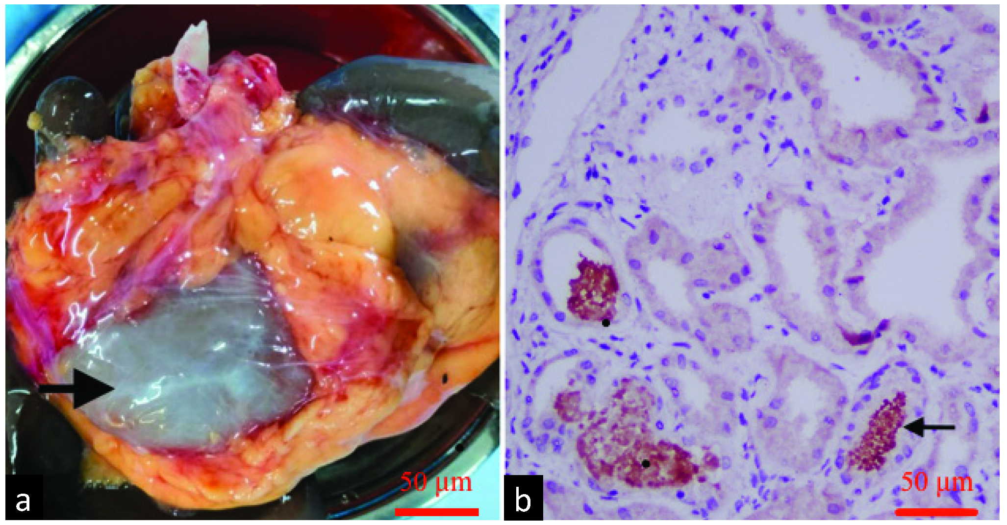 (a) Bluish discoloration at the time of retrieval (black arrow). (b) Post-operative day 5 biopsy showing myoglobin cast deposition within the tubules (black arrow). Image courtesy: RENOPATH.
