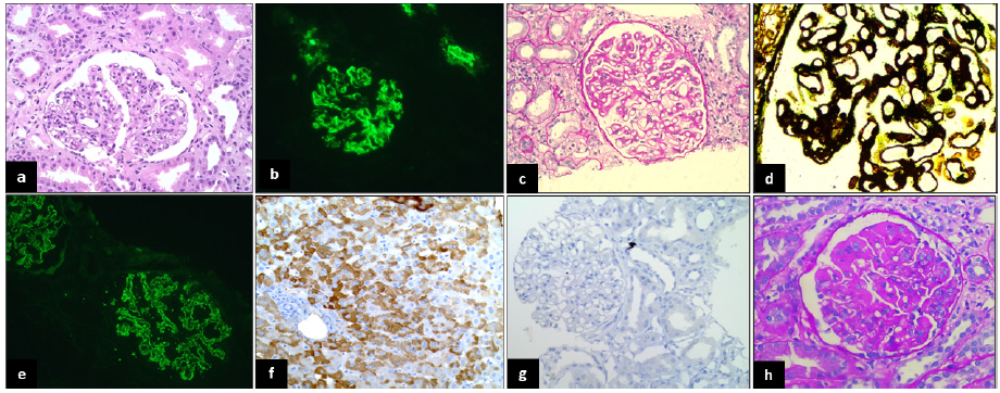 IgA nephropathy: (a) Glomerulus shows diffuse mesangial hypercellularity (H&E,400x); (b) 3+ glomerular mesangial immune deposit (IF,400x). Membranous nephropathy (MN): (c) Glomerulus is enlarged with thickened and stiff capillary loops (PAS,400x); (d) Glomerulus showing subepithelial argyrophilic spikes (PASM, 400x); (e) 3+ fine granular subepithelial immune deposits (IF, 400x). (f) Positive control of Hepatitis B-virus (HBV) surface antigen IHC in a case of HBV positive liver biopsy (IHC,400x); (g) A case of MN negative for immunohistochemistry (IHC,400x). Cryoglobulinemic glomerulonephritis: (h) Glomerulus shows fuchsinophilic subendothelial deposits and intra-capillary hyaline thrombi (MT,400X).